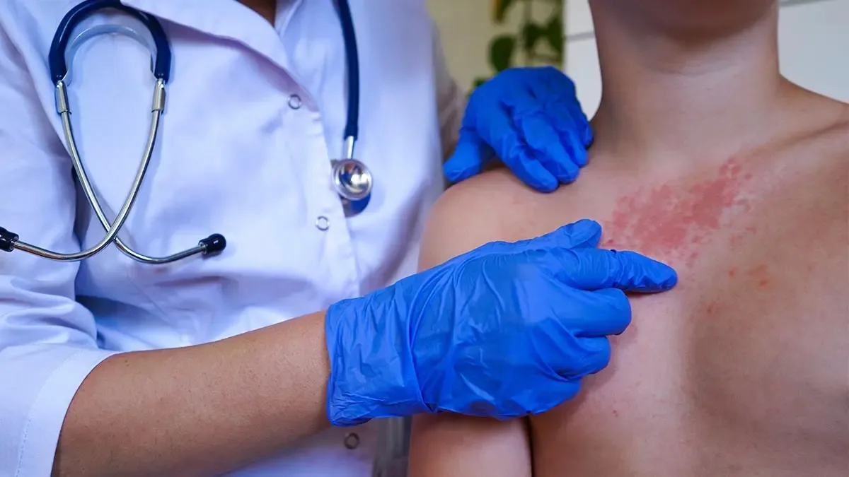 Aumento de casos de sarampión en Baja California preocupa a autoridades de salud.