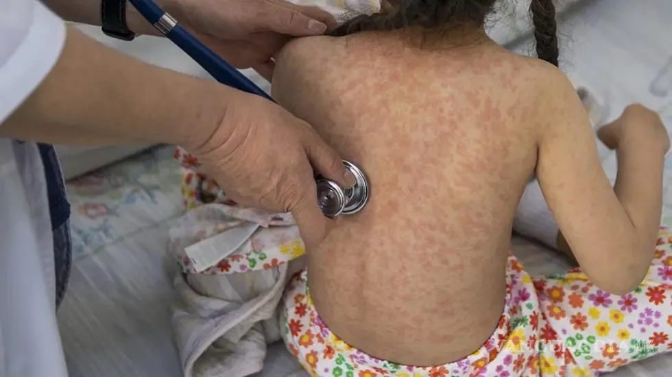 "Aumento de contagios de sarampión en México en 2026 según la Secretaría de Salud."