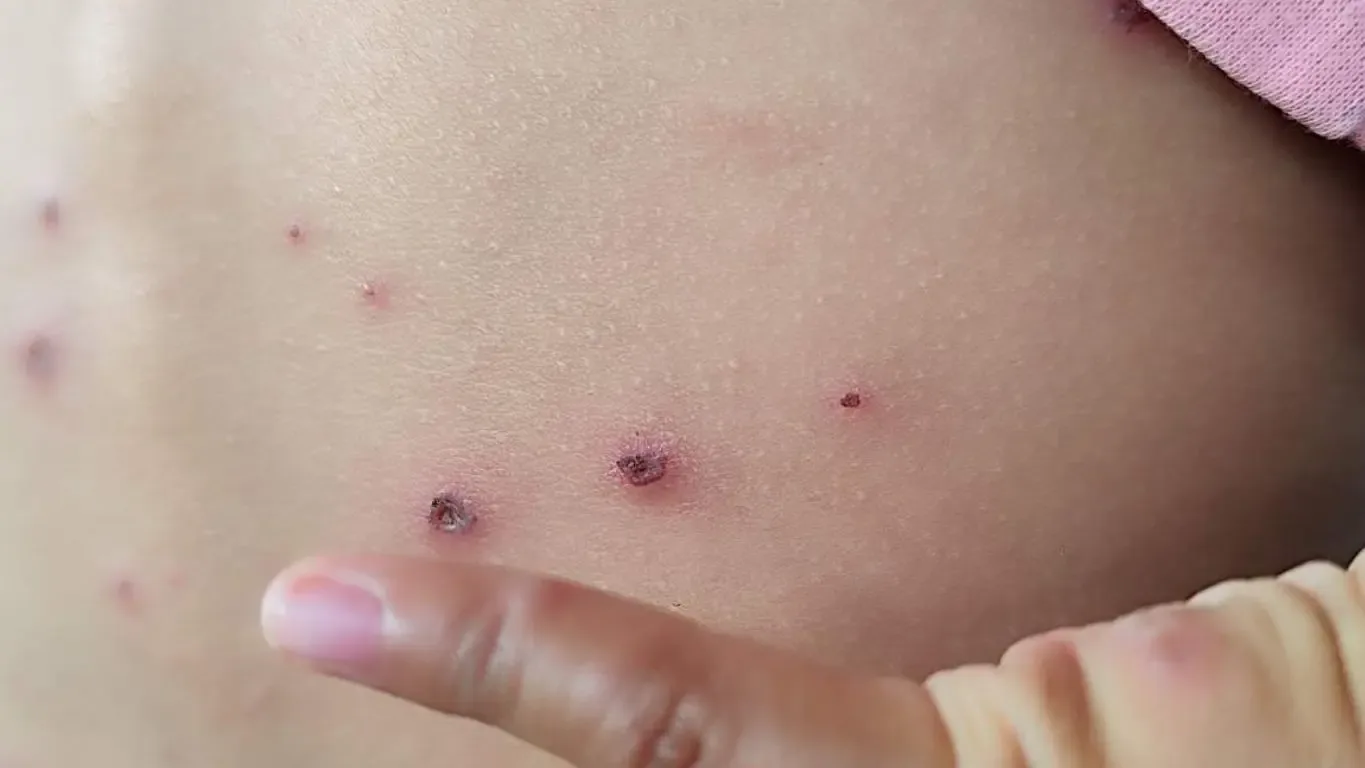 "Casos de sarampión en Puebla llevan a autoridades a activar alerta sanitaria."
