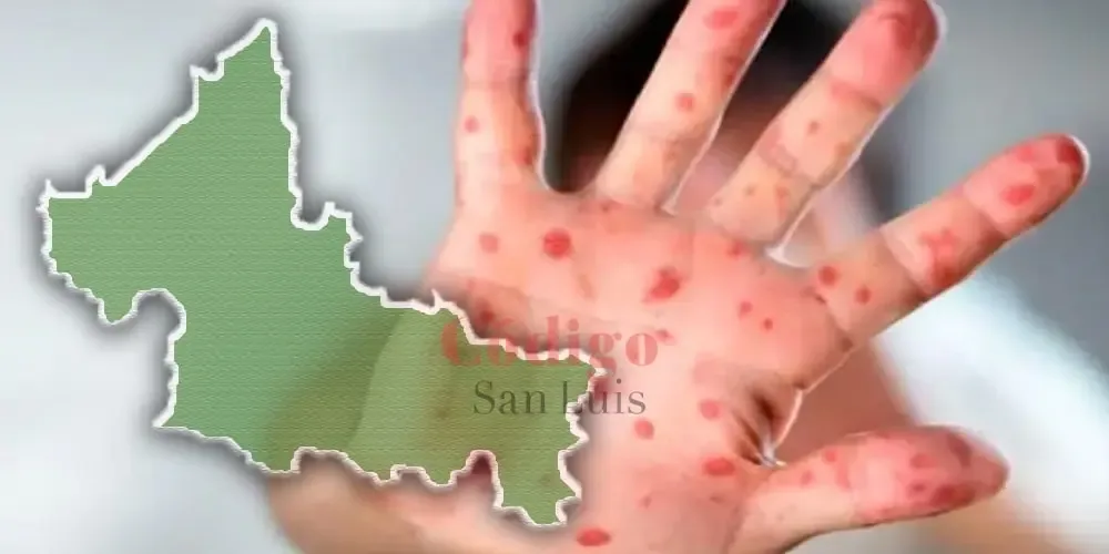 Casos de sarampión en San Luis Potosí despiertan alarma en la población.