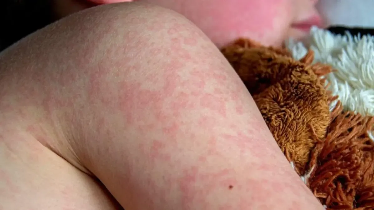 Con más de 10 mil infectados, la salud pública lanza recomendaciones para prevenir el sarampión.