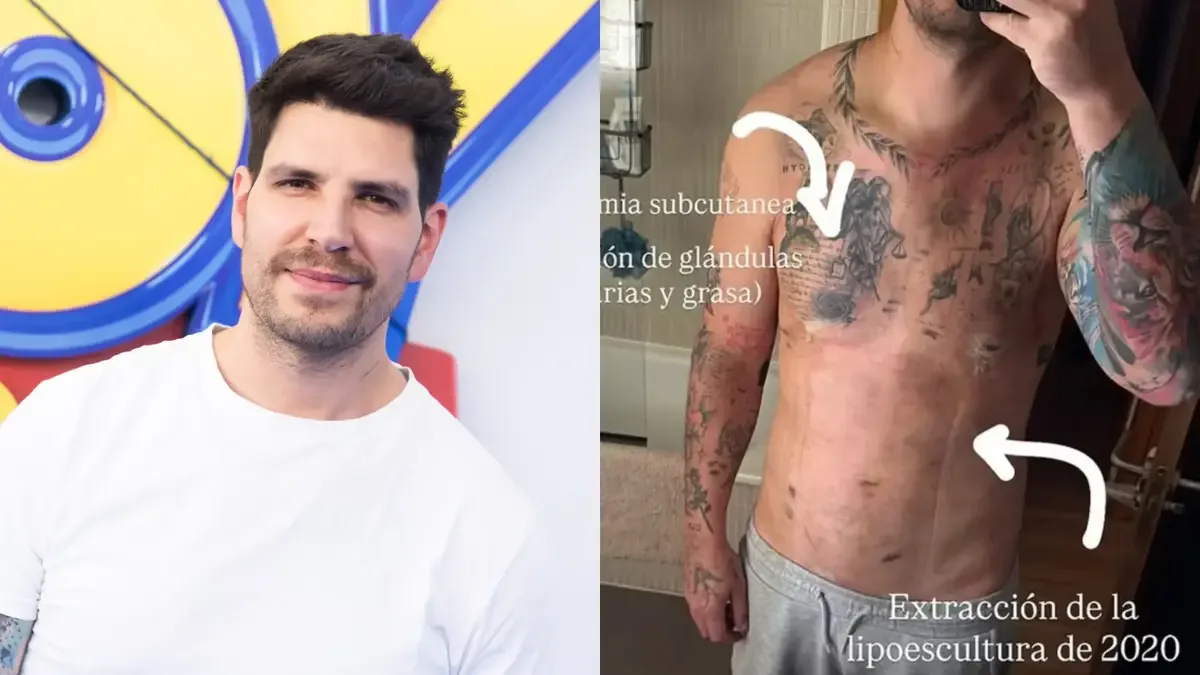 El influencer comparte su experiencia tras una intervención y reflexiona sobre el uso de esteroides.