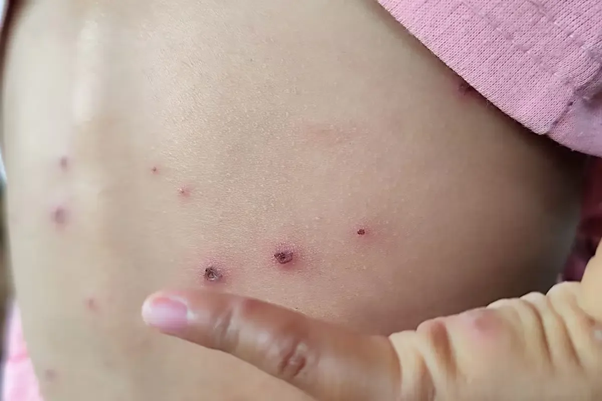 El brote de sarampión se intensifica en el país, afectando principalmente a niños.