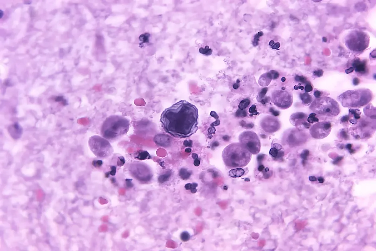 La infección por Naegleria fowleri provoca meningitis mortal en el 97% de los casos.