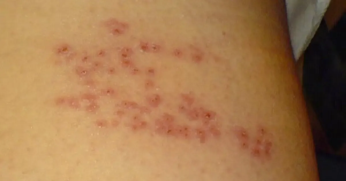 La reactivación del virus varicela-zóster exige atención médica temprana para evitar problemas de salud.