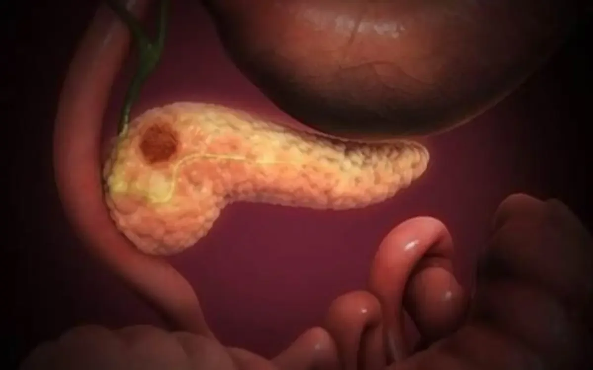 Investigadores del CNIO presentan el avance en la eliminación del cáncer de páncreas.