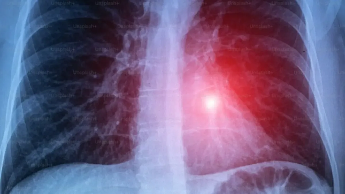 La tuberculosis respiratoria presenta un aumento del 31% en comparación con el año anterior.