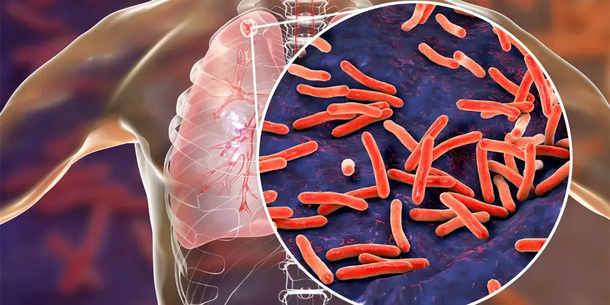 México reporta un incremento preocupante de tuberculosis en enero, aumentando el riesgo sanitario.