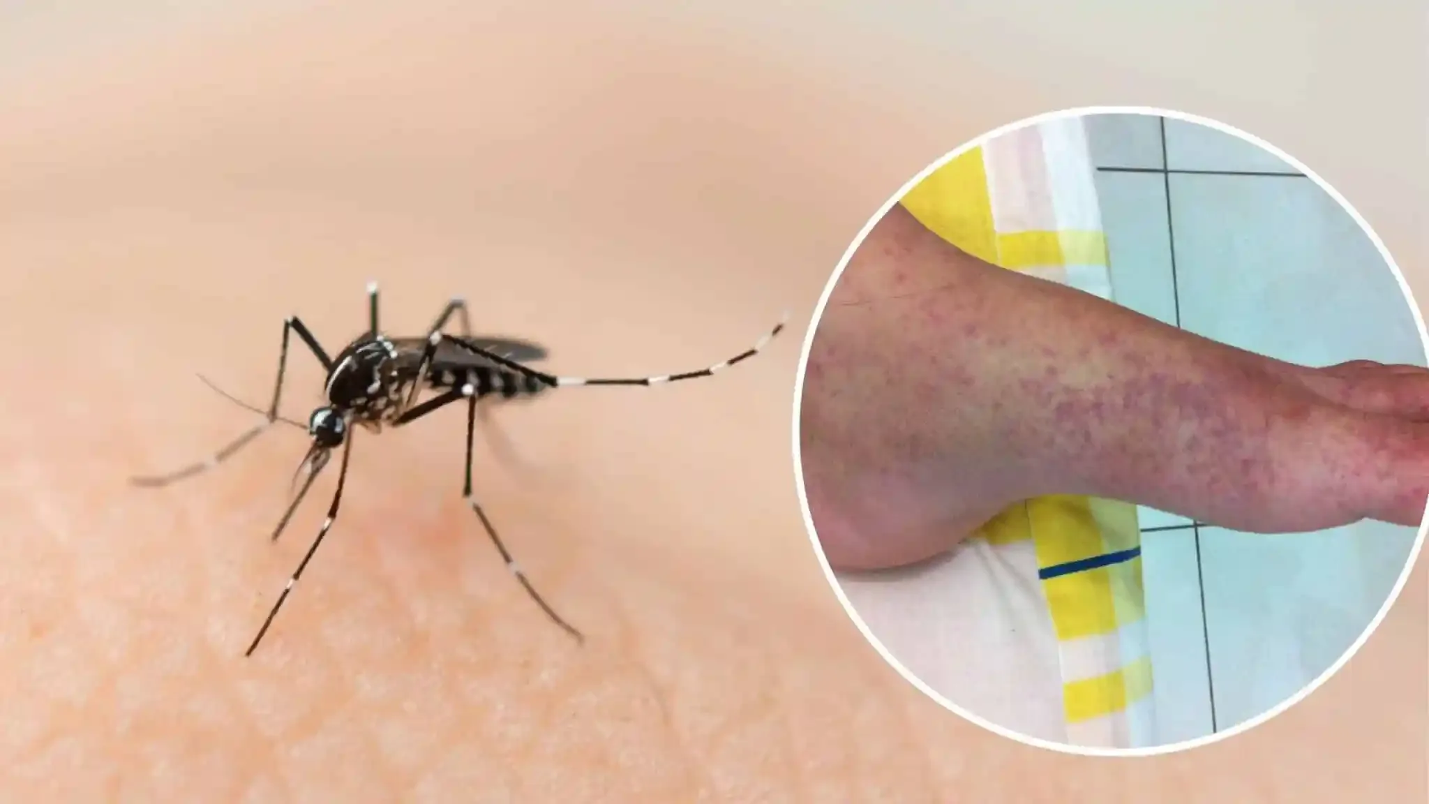 Primer caso de chikungunya en Quintana Roo en 2026 genera alerta sanitaria.