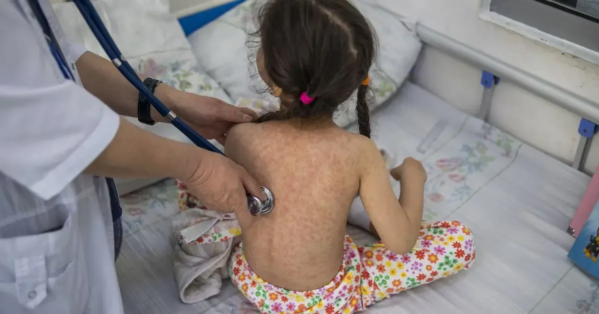 Un caso de sarampión en Pérez Zeledón destaca la importancia de la vacunación en el país.