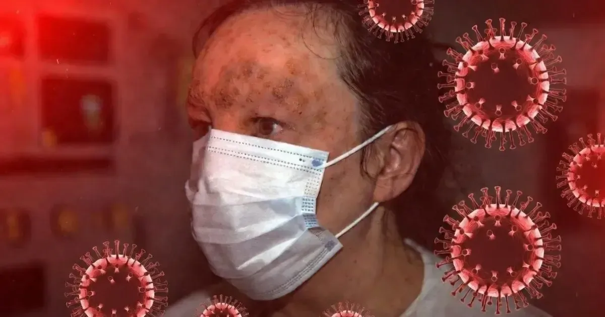 Un incremento alarmante en casos de viruela símica es reportado en el país, con la Ciudad de México liderando la cifra.