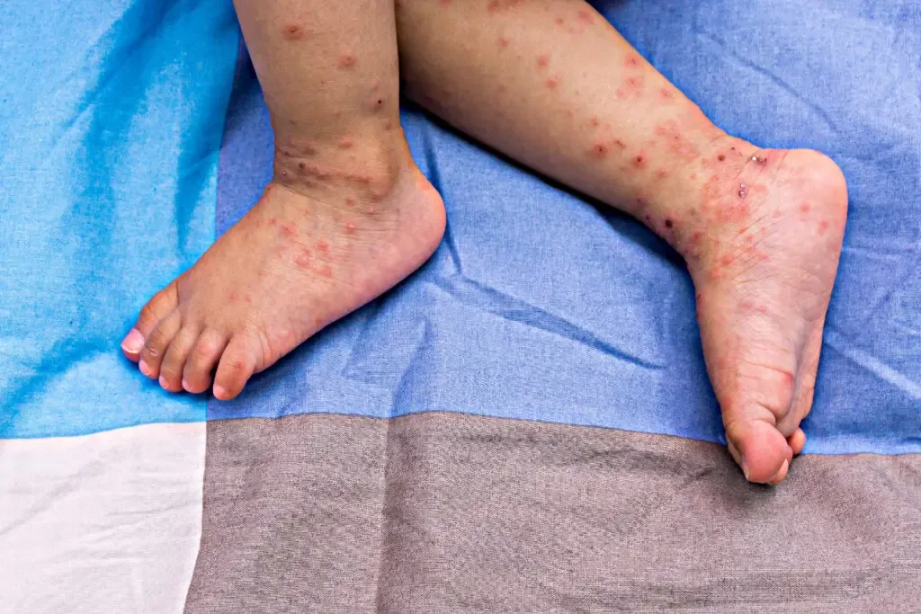 Una niña de 6 años presenta sarampión; se implementan medidas de control en la zona.